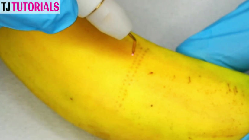 Plasma Fibroblast Patterns & Techniques _ EP 1 _ Heptagon & 5 Point.mp4